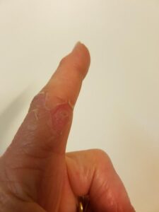 finger mit katzenbis nachher